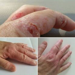 Eczema Before & After