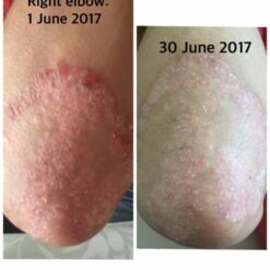 Psoriasis Before & After Oasis Balm