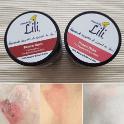 2nd Degree Burns Renew Balm