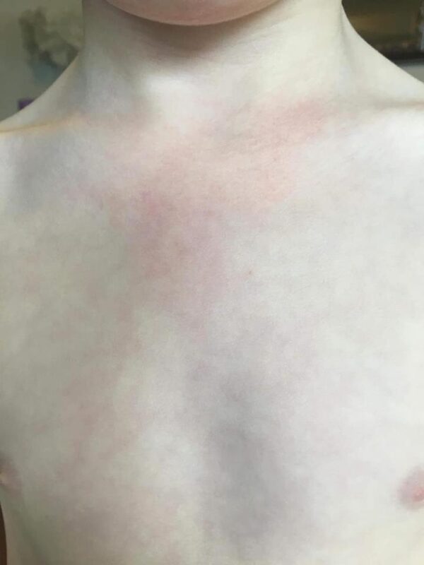 After 2nd Degree Burns