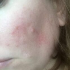 Anguish of Rosacea with Acne