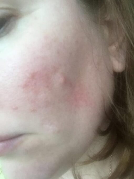 Anguish of Rosacea with Acne