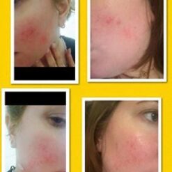 Rosacea Before & After