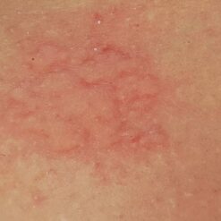 Stung by Jellyfish