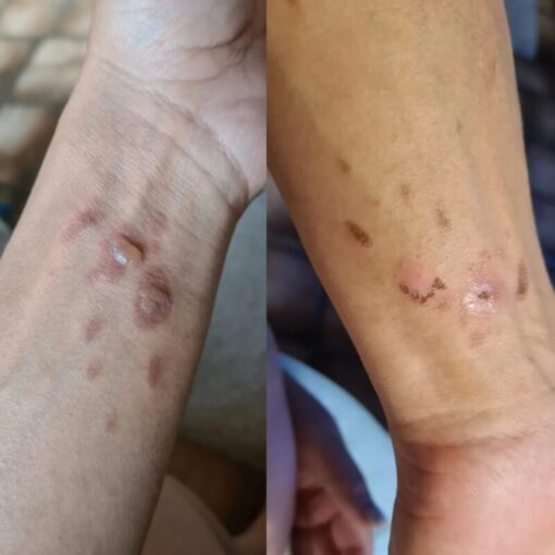 Burns Before & After 5 Days using Renew Balm Aug23